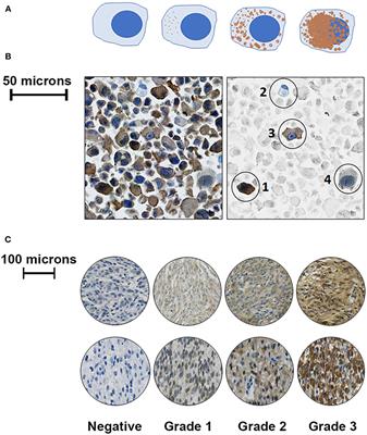 Immunohistochemical Characterization of Procaspase-3 Overexpression as a Druggable Target With PAC-1, a Procaspase-3 Activator, in Canine and Human Brain Cancers